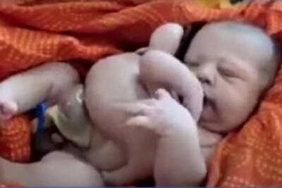 В Индии родился ребенок с восемью конечностями - mk.ru - Индия