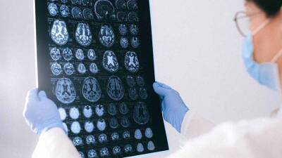 Инсульт, миелит и делирий: вирусолог рассказал, как нейроковид влияет на мозг - vm - Москва