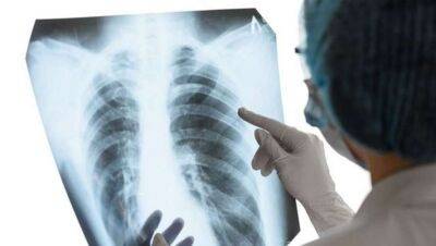Медики назвали 6 наиболее распространенных симптомов туберкулеза - lenta.ua - Украина