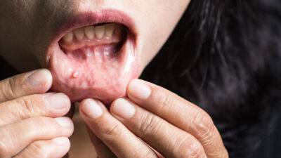 Следите за ртом: вот симптомы, которые указывают на начало серьезных болезней - vesty.co.il - Израиль